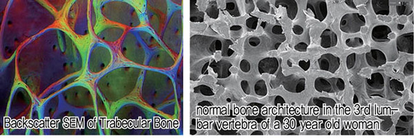 Figure 3-2. 30대 여성환자의 해면골 trabecular pattern을 관찰하면 골수강의 활성도를 볼수 있는 줄기의 활성현상을 볼 수 있다.
